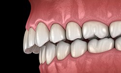 Digital illustration of an overbite