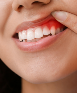 Woman lifting up the corner of her lip to reveal swollen gums
